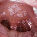 kandida u usnoj supljini